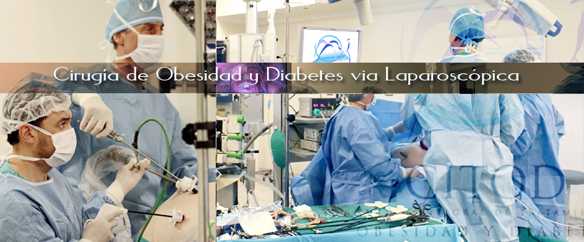 Cirugía de Obesidad y Diabetes con Técnica Laparoscópica